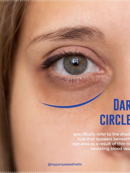 Dark circles are the shadowy hue that appears due to thin tissue revealing blood vessels, often caused by genetics, pigmentation, or lack of sleep.