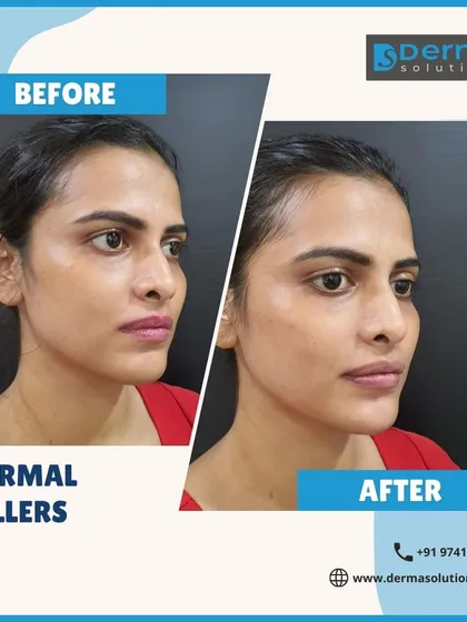 This is another example of how dermal fillers can be used for overall facial rejuvenation. By strategically adding volume to the mid-face, I was able to lift the cheeks and soften the lines around the mouth for a subtle yet effective result.