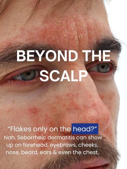 Seborrheic dermatitis is not just limited to the scalp. It can cause flaking and redness on the face, eyebrows, beard area, and even the chest. I treat the condition wherever it appears.
