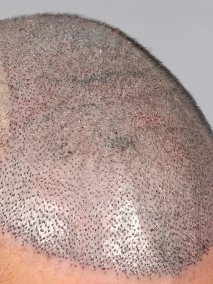 Immediate post-surgery view of a Norwood Grade 5A transformation. 5000 grafts were used to recreate the hairline and restore the frontal and mid-scalp regions.