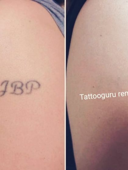 This shows the removal of initials from the shoulder area. Black ink like this generally responds very well to the laser treatment.