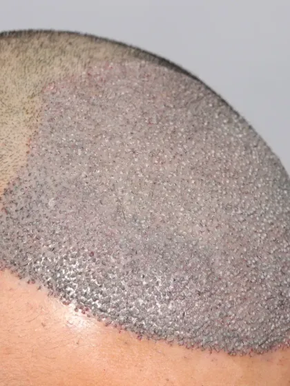 The start of a journey for a Diffuse Grade 4A patient. 3500 grafts were used to recreate the hairline, frontal zone, and mid-scalp.