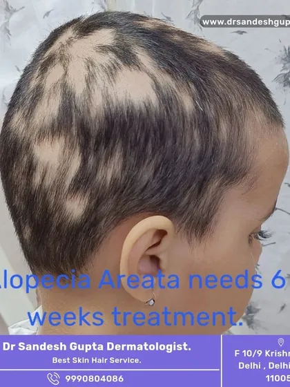 This is a case of Alopecia Areata in a young child, a condition that causes patchy hair loss. With a targeted 6-week treatment plan, we can effectively manage the condition and stimulate hair regrowth. It is a treatable condition.