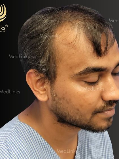 Before his transformation, this patient was dealing with noticeable hair loss at the temples and crown. This is a typical stage where intervention can yield excellent, confidence-boosting results.