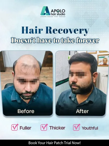 This is the result of our non-surgical hair patch treatment. We gave this client a fuller, thicker, and more youthful hairstyle that seamlessly covers the area of hair loss on his crown and front, achieving a completely natural look in a single session.