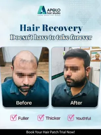 Non-Surgical Hair Replacement