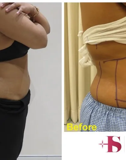 A side profile view of a liposuction procedure. The 'before' image shows the surgical markings I use to plan the fat removal from the abdomen and flanks. The 'after' image reveals a smoother, flatter contour and a significant reduction in the bulge that concerned the patient.