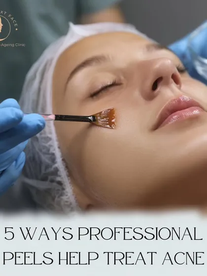 Here are 5 ways our professional chemical peels help treat acne.