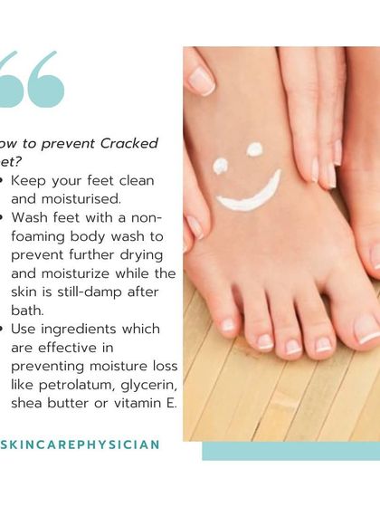 To prevent cracked feet, keep them clean and moisturized. Use a gentle body wash and apply a moisturizer with ingredients like petrolatum or shea butter while the skin is still damp.