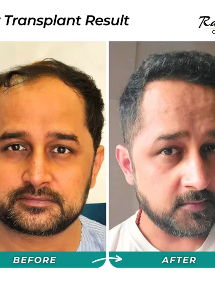 A fantastic result showcasing a restored hairline and significant density improvement. The patient looks younger and more confident after the procedure.
