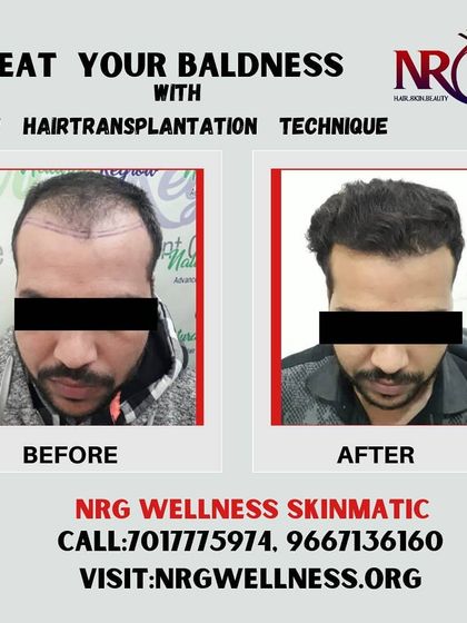 We help you beat baldness with our advanced hair transplantation techniques. This client's before and after photos show a significant improvement in hair density and overall look.