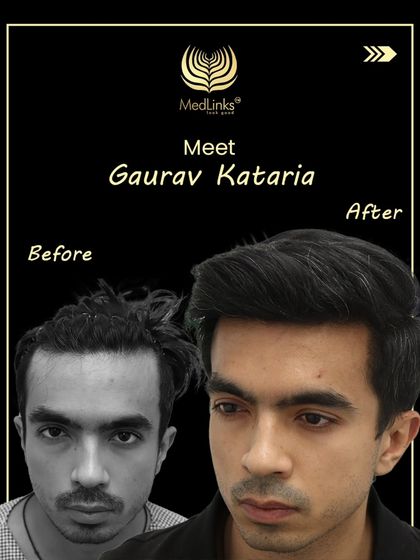 A before and after collage for Gaurav Kataria, who came to us with Grade 2 hair loss and left with a confident new look.