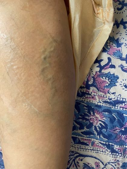 This photo was taken part-way through the treatment process. You can already see a visible reduction in the prominence and discoloration of the veins as our therapy begins to take effect.