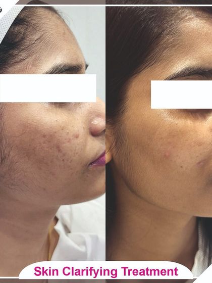 This image shows how our treatments can address both pigmentation and unwanted facial hair, leading to an overall clearer and smoother look.
