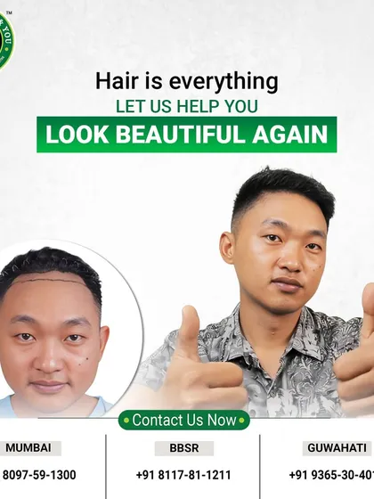 The thumbs-up says it all. This client's journey from a pre-marked hairline to a full, happy result is a testament to the effectiveness of a well-executed FUE hair transplant. It’s not just about hair, it’s about feeling great again.