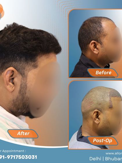 Another complete journey from before to post-op to a fantastic final result. This visual story demonstrates the effectiveness and predictability of my FUE hair transplant technique.