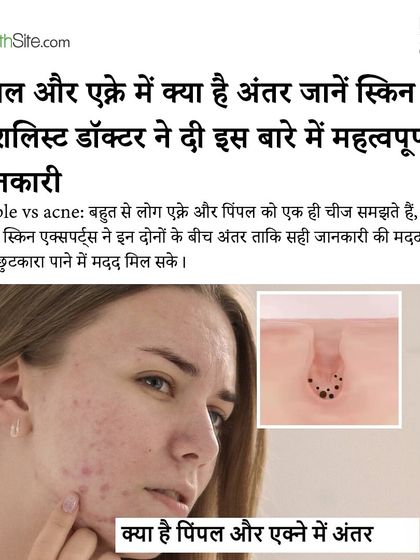 The headline from my feature in The Health Site, where I provide important information on the difference between pimples and acne.