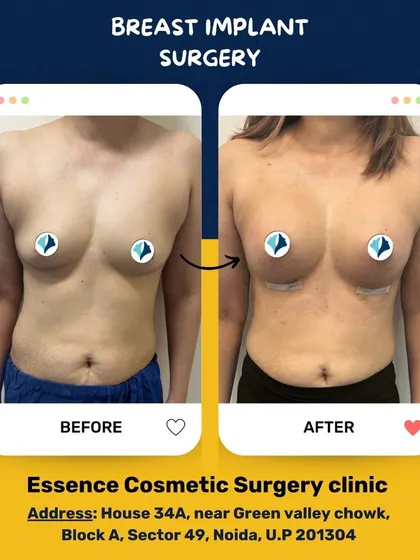A clear before and after of a breast implant surgery. The result shows enhanced volume and a fuller, more symmetrical shape, achieving a natural-looking augmentation.