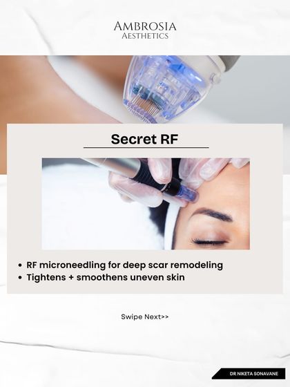 Secret RF is an advanced RF microneedling device I use for deep scar remodeling. The combination of microneedles and radio frequency energy helps tighten and smoothen uneven skin from the inside out.
