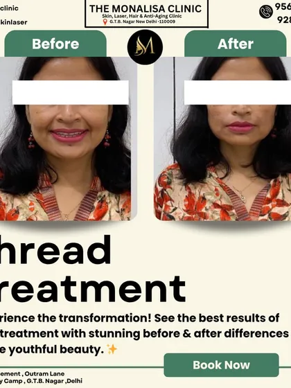 See the transformative power of a non-surgical thread treatment. This client's 'before' and 'after' photos highlight a noticeable lift in the lower face and jawline, resulting in a more defined and youthful facial contour with minimal downtime.
