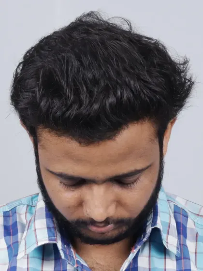 A fantastic 6-month result after implanting 5000 grafts. We recreated the hairline and filled the mid-scalp and crown area.