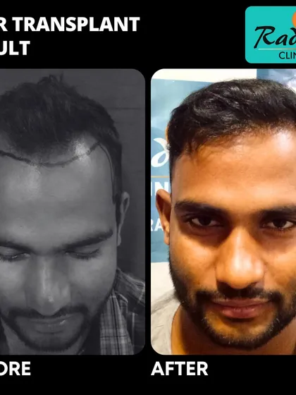 This before-and-after shows the journey from a significantly receded hairline to a full and dense frontal region. The result is a complete and natural-looking restoration.