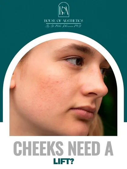 Do your cheeks need a lift? As we age, we lose volume in the mid-face. Cheek fillers can restore that youthful contour, providing a subtle lift to the entire face.