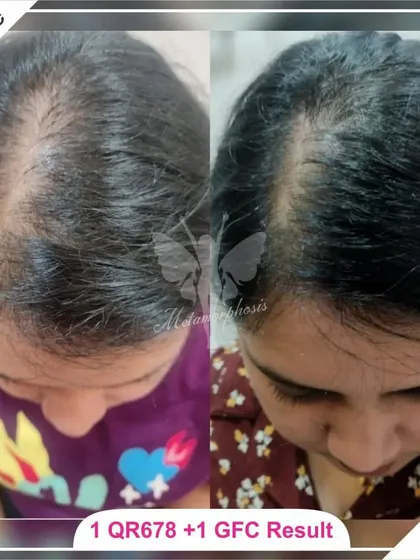 This client's fantastic result was achieved with a combination therapy of just one QR678 session and one GFC session. This shows how I tailor treatments to get effective results efficiently.