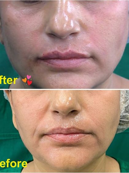 This before and after demonstrates the immediate effect of hyaluronic acid fillers for lip plumping. My technique focuses on enhancing the natural shape and volume of the lips, correcting asymmetries and providing a fuller, yet balanced, look.