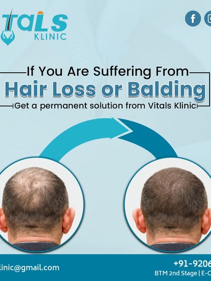 Vitals Klinic - Hair Restoration & Treatment FUE Hair Transplantation: A Permanent Solution photo 8