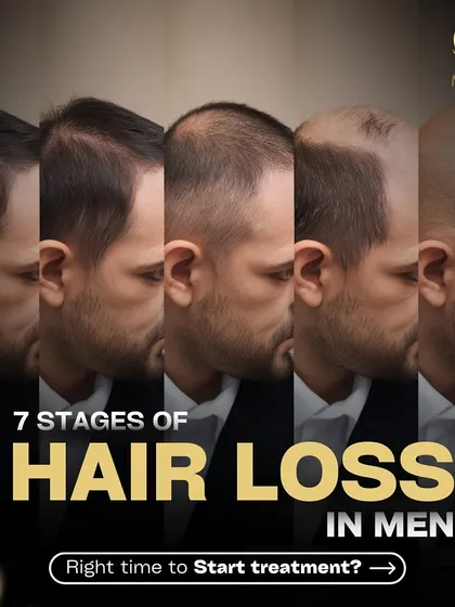Hair loss happens in predictable stages. Understanding where you are on this scale, from minimal thinning to more advanced patterns, is key to choosing the right treatment. This guide helps you identify your stage of male pattern baldness so we can discuss the most effective solutions for you.