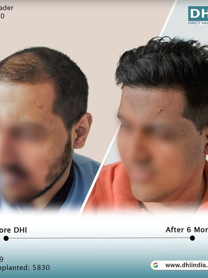 Another side-profile view of the 6-month transformation. This angle highlights the seamless integration of the new hair, creating a natural and aesthetically pleasing outcome.