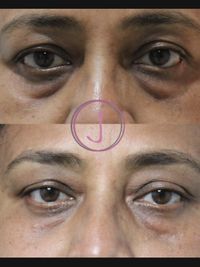 Anti-Aging & Skin Tightening