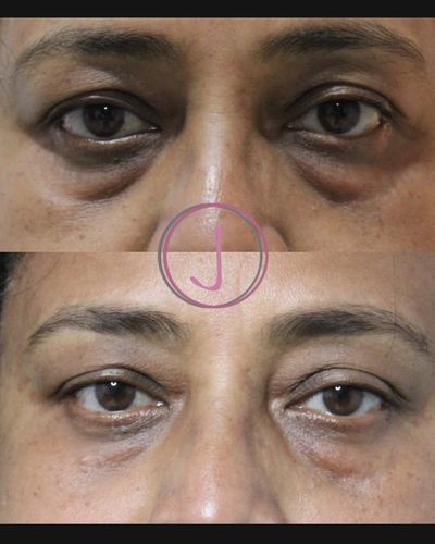 Anti-Aging & Skin Tightening