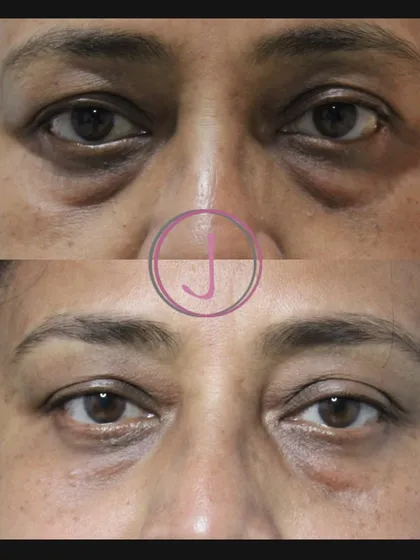 Tired of looking tired? Under-eye puffiness is a common concern, but it doesn't have to be permanent. This before-and-after shows the significant reduction in eye bags after just one session of PDO threads, helping my patient look rested and rejuvenated.