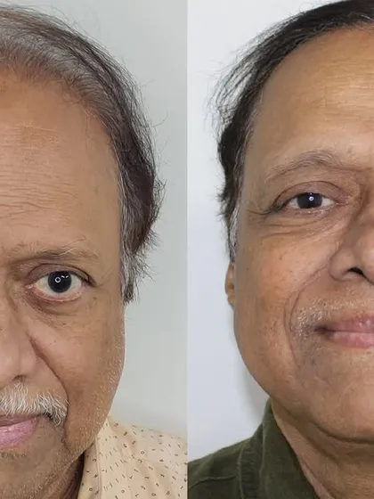 It's never too late for a hair transplant. This gentleman, at 64 years old, was dealing with advanced Grade 7 baldness. I performed a comprehensive restoration that has taken years off his appearance, proving that age is not a barrier to regaining your hair.