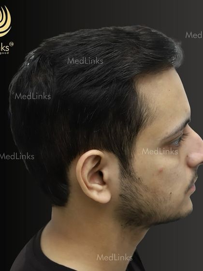 The final result from the side, showing a natural and dense hairline.