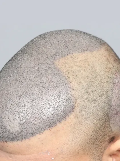 The result of implanting 5900 grafts for a Diffuse Grade 6 patient, showing the density and coverage achieved.