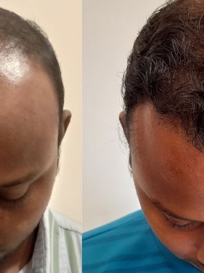 Here, we addressed both hairline recession and crown thinning. This image focuses on the successful restoration of the crown area, which now has excellent coverage.