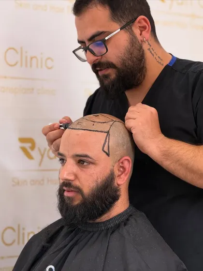 Precision is everything. Here, one of our Turkish experts is meticulously designing the beard line before the procedure. We don't do cookie-cutter looks; we create a custom shape that perfectly fits your face structure for a 100% natural result.