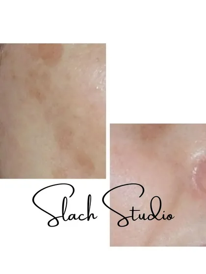 This image shows the successful treatment of melasma, with the dark patches visibly lightened and the skin texture improved.