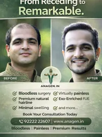 Hair Transplant Surgery