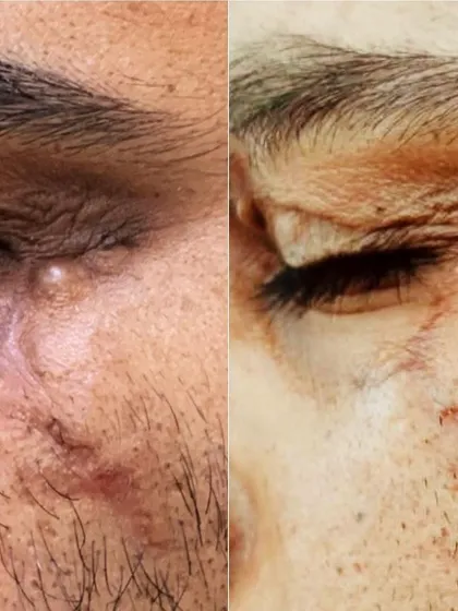 This image shows the outcome of a surgical scar revision procedure for a prominent scar located near the eye. Our goal with scar revision is to make the scar less conspicuous by altering its size, texture, and direction, leading to a significant cosmetic improvement.
