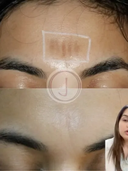 This before-and-after shows the successful treatment of a depressed scar on the forehead. We used targeted procedures to stimulate collagen and raise the indented tissue, making the scar much less noticeable.