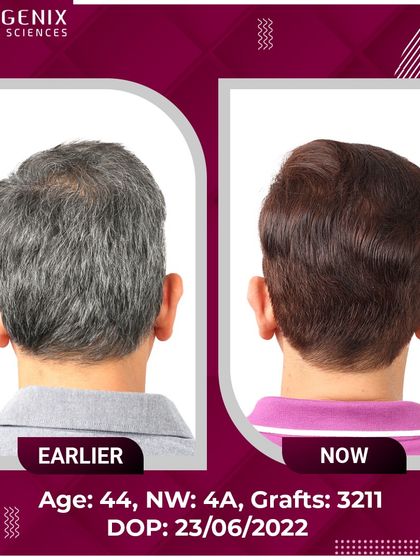 Real results for real people: a 44-year-old's successful 3211-graft transplant.