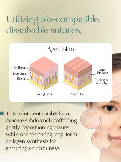 This diagram explains how thread lifts work. By utilizing bio-compatible, dissolvable sutures, we establish a delicate subdermal scaffold that gently repositions tissues while stimulating long-term collagen synthesis for enduring youthfulness.