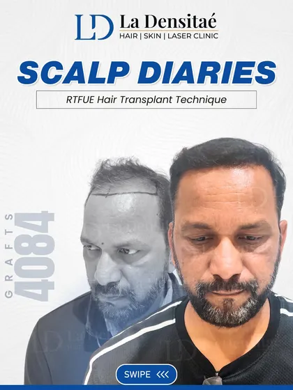 With 4,084 grafts, I helped Mr. Liyakat Hussain turn the page on his hair loss story. Using the RT-FUE technique, we focused on restoring his natural hair pattern and density, which in turn brought back his confidence.