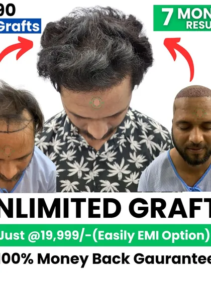 With 3590 grafts, this is the result after 7 months. We also offer a 100% money-back guarantee and easy EMI options.