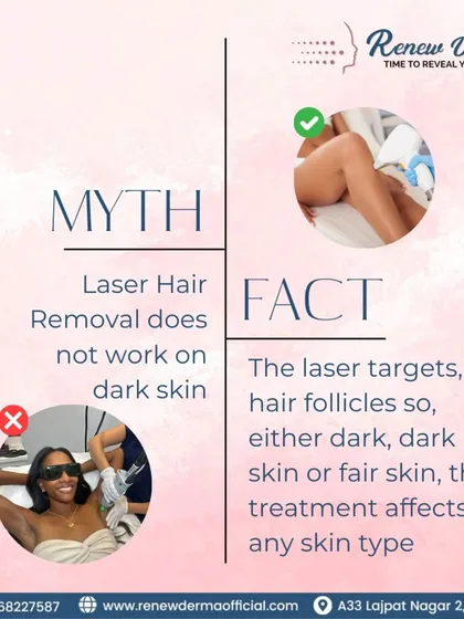A common myth is that laser hair removal doesn't work on dark skin. This is a fact check. Our modern lasers target the hair follicle, making the treatment effective on any skin type, whether fair or dark.