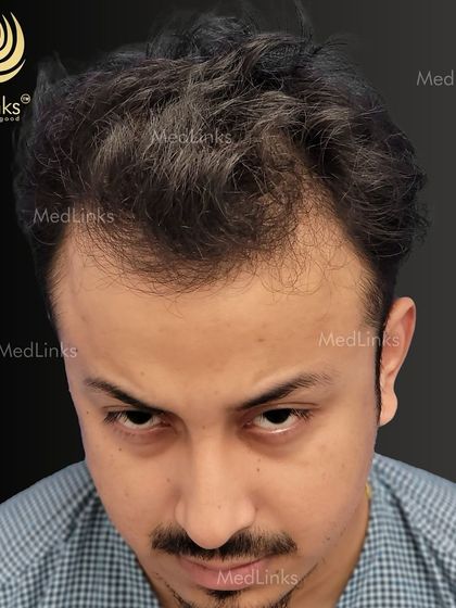 A top-down view of the patient's hair loss before the transplant.